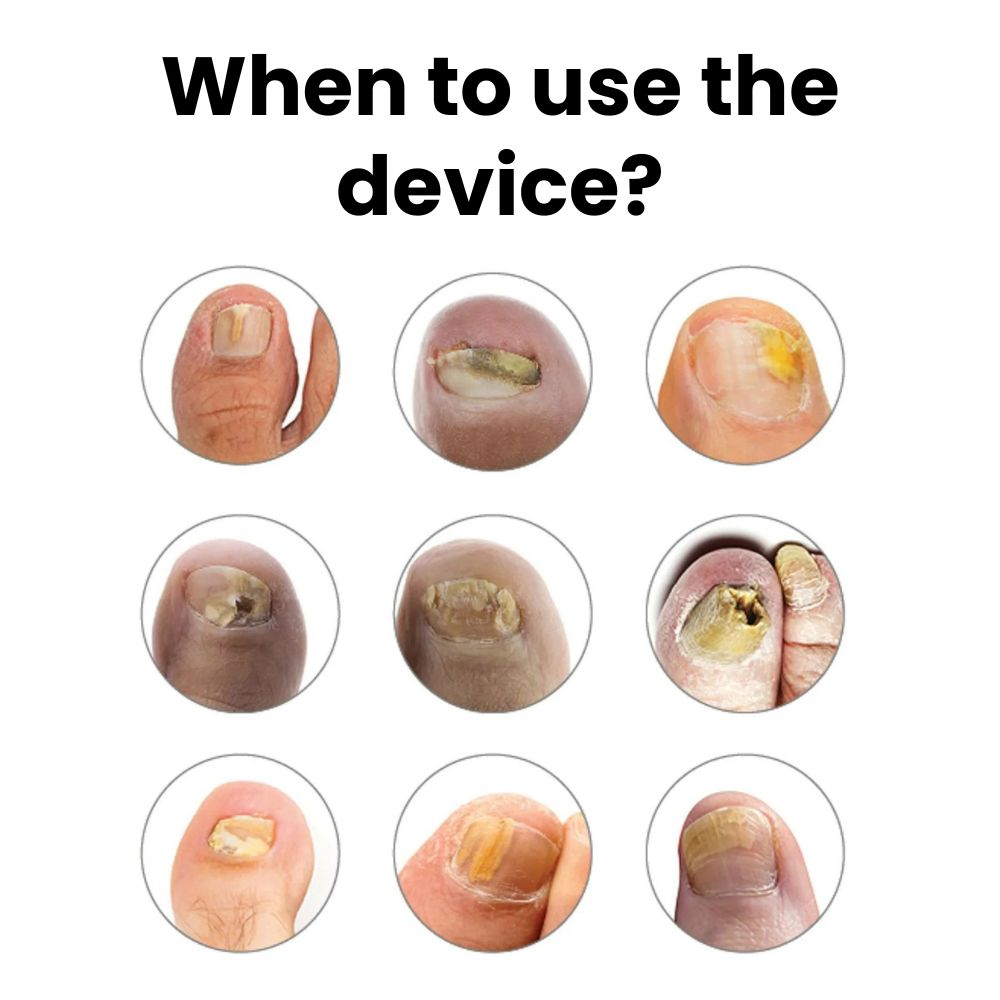 YOYOLE Anti-Fungal Device