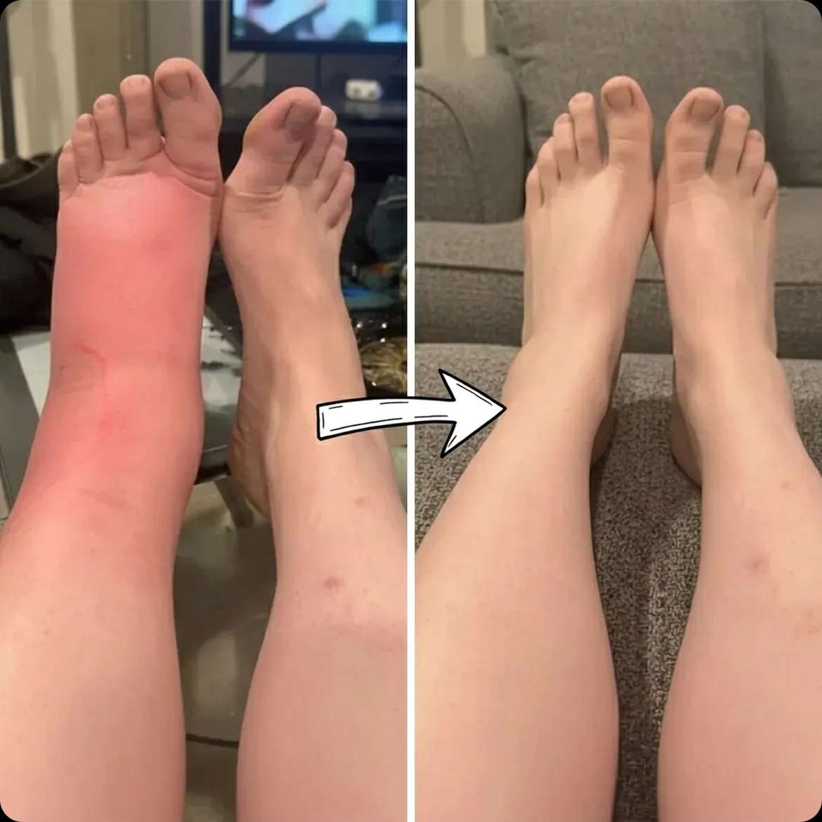 My Swollen Feet Are Gone, The Heavy Aching Has Stopped, And I Can Finally See My Ankles Again