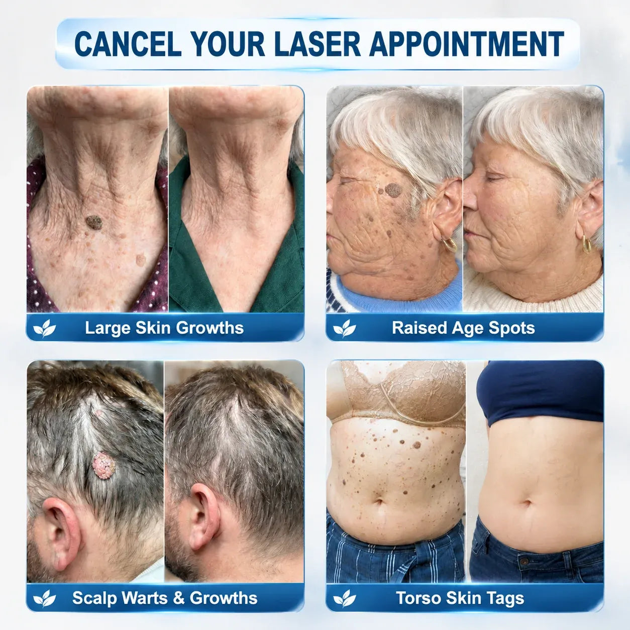 Professional Skin Tag & Spot Removal YOYOLE