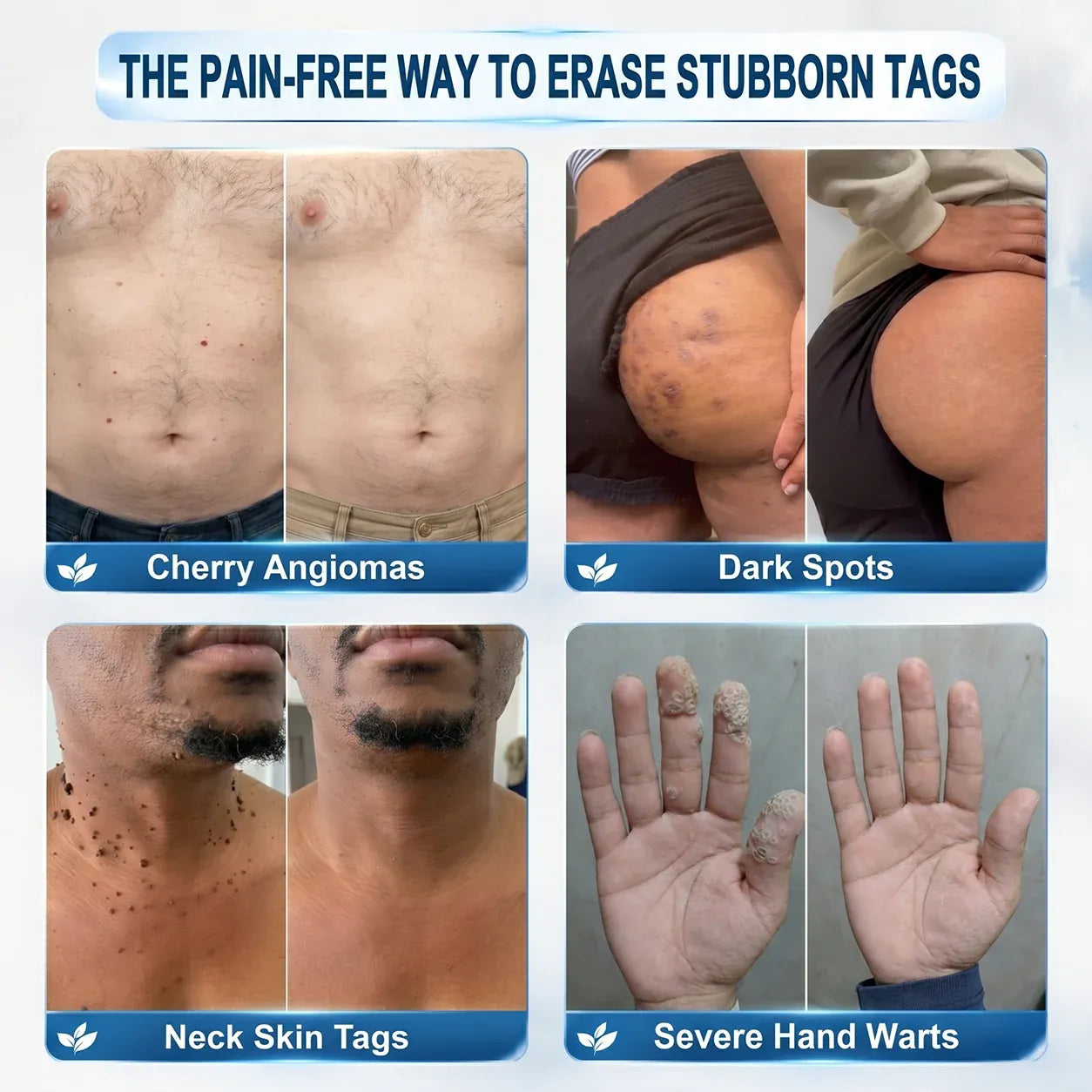 Professional Skin Tag & Spot Removal YOYOLE
