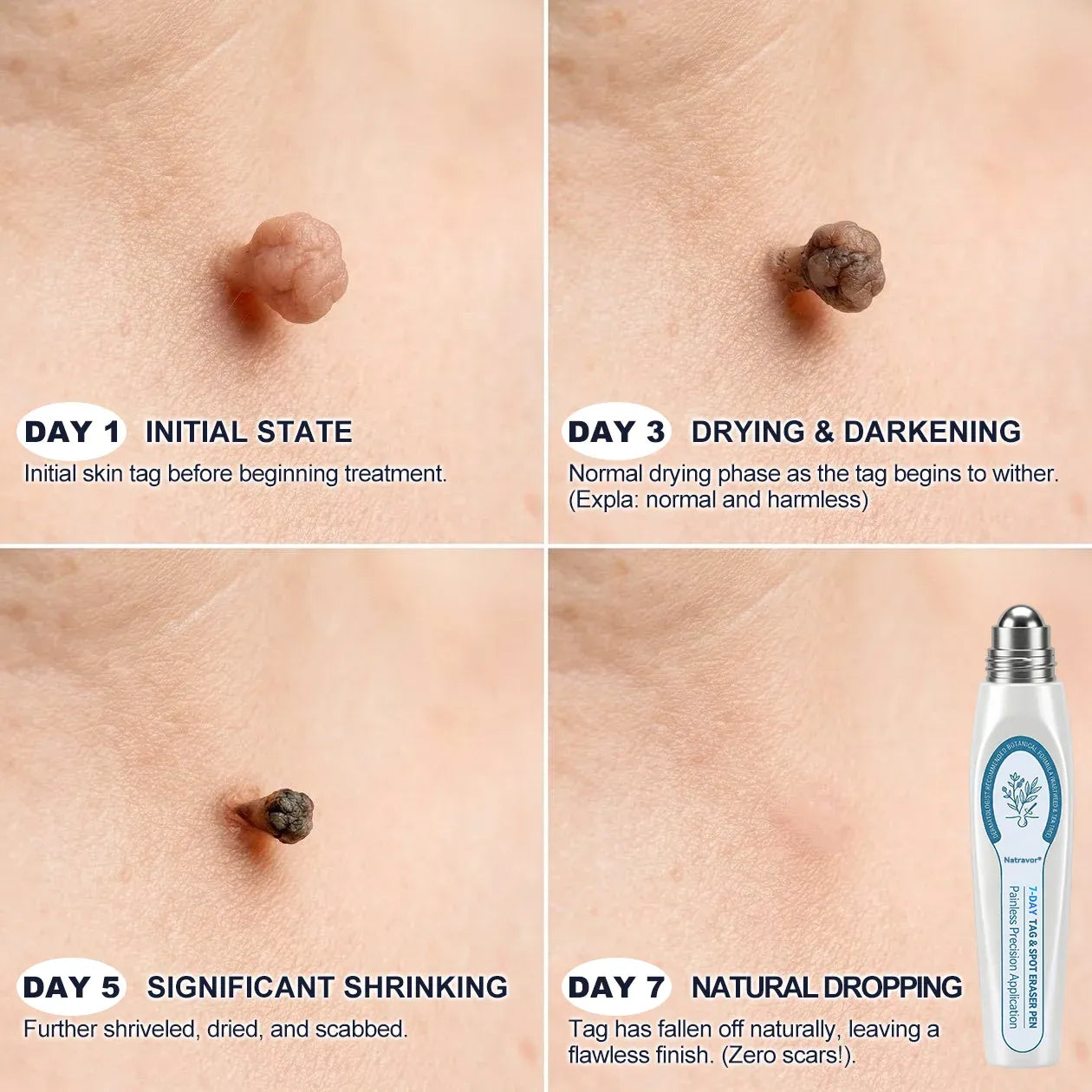Professional Skin Tag & Spot Removal YOYOLE